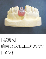 【写真5】前歯のジルコニアアバットメント