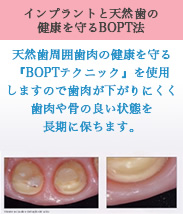 インプラントと天然歯の健康を守るBOPT法